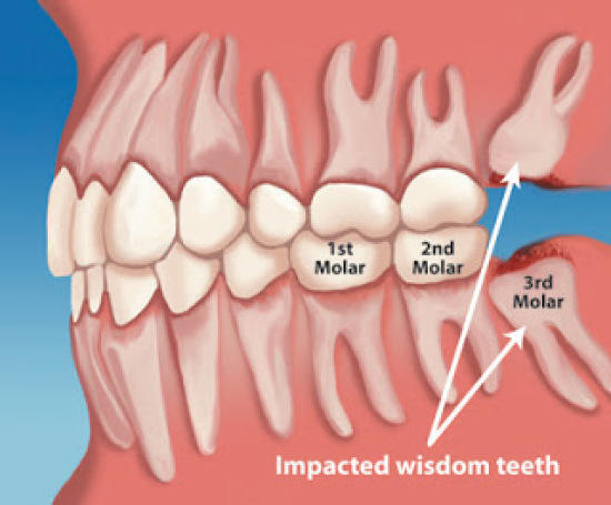 Wisdom Teeth Woes: From Impaction to Inflammation Part 1