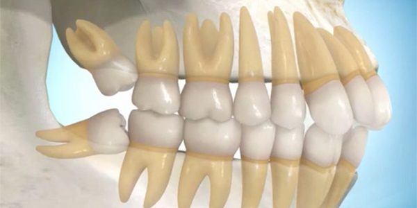 Wisdom Teeth Uncovered: Myths, Misgivings & Modern Truths – Part 2