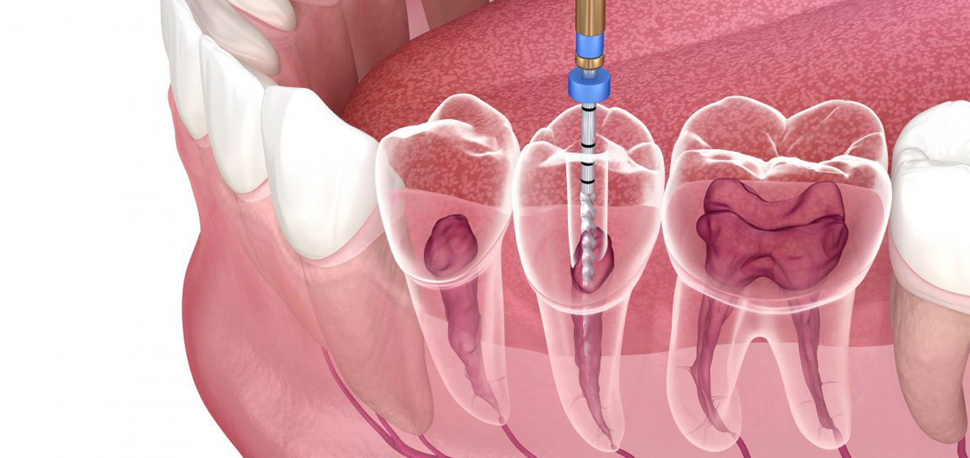 Understanding Root Canal Treatment: What You Need to Know