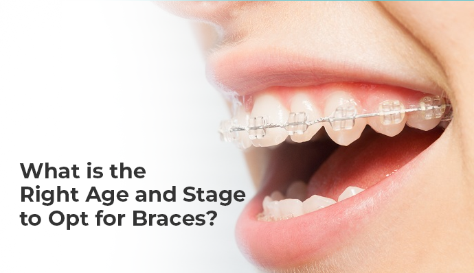 What Is the Right Age for Braces or Orthodontic Treatment