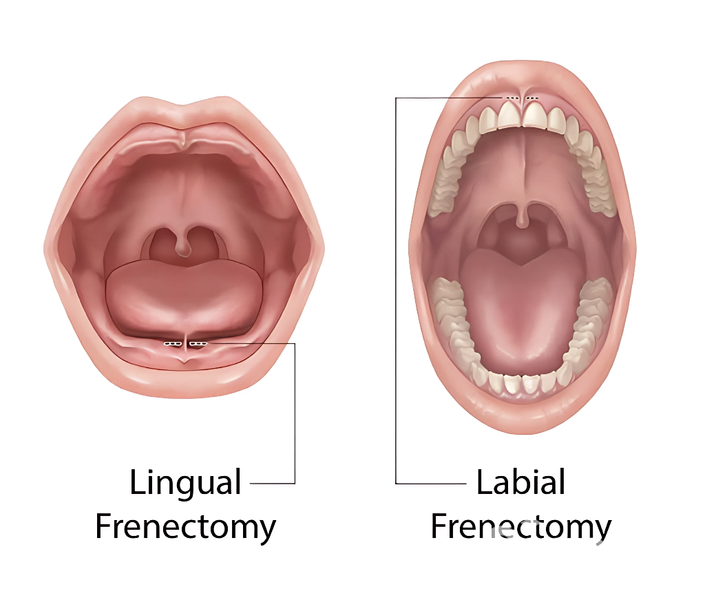 Frenectomy Explained: How It Can Boost Speech, Eating, and Oral Health