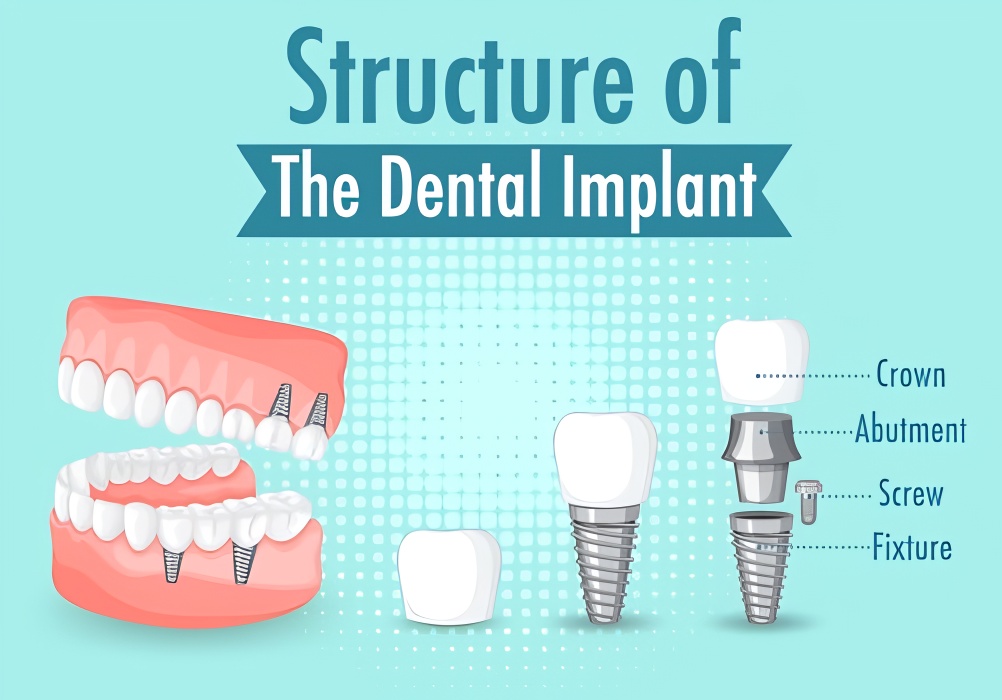 Dental Implants: A Permanent Solution for Missing Teeth