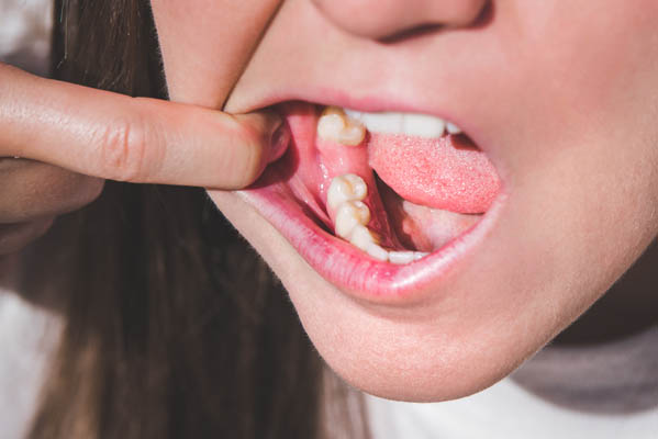 What to Do After a Tooth Extraction: Essential Healing Tips