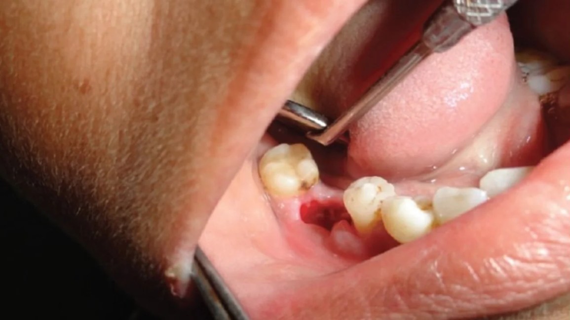 Dry Socket Demystified: What It Is, Why It Happens, and How to Prevent It