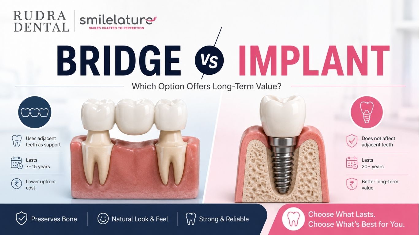 Dental Bridge vs Implant: Which Option Offers Long-Term Value?